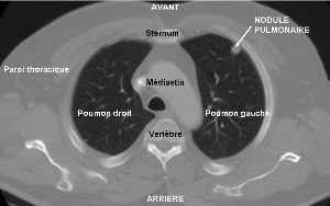 Image médicale : Scanner présentant un nodule pulmonaire