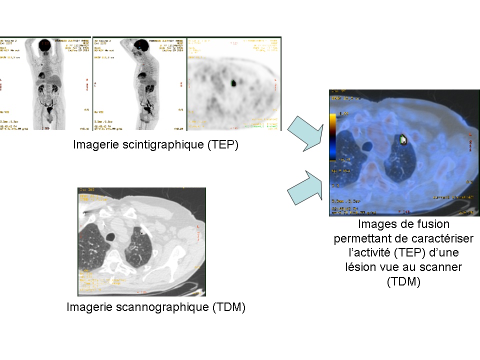 Image médicale : TEP scanner